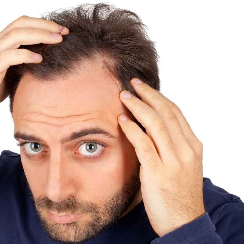 What are the Myths & Facts Associated with the Hair Transplantation