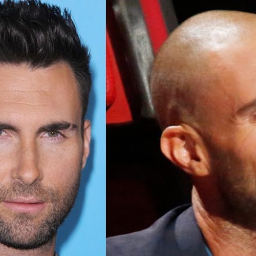 What is Needed to Create a Good Hairline in Hair Transplants