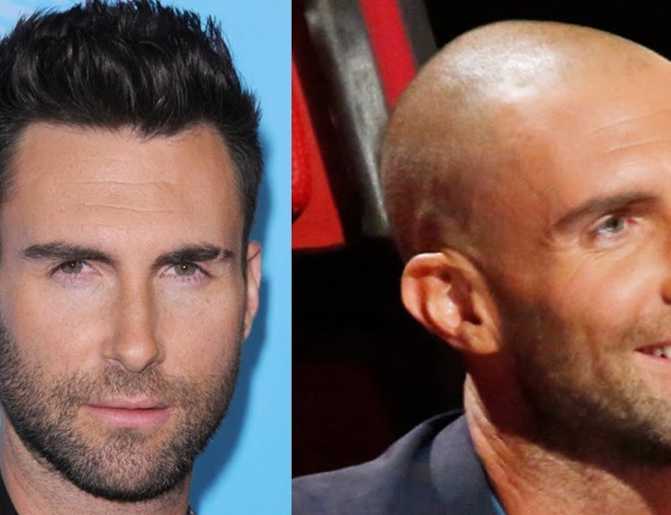 What is Needed to Create a Good Hairline in Hair Transplants