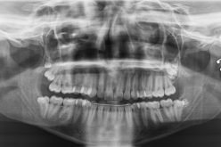7 Possible Complications Of Impacted Wisdom Teeth