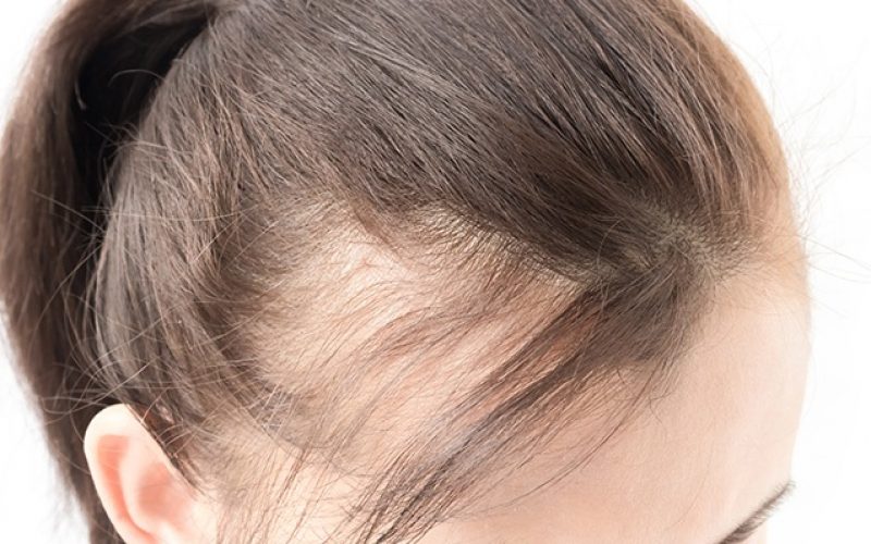 Who’s the Right Candidate for PRP for Hair Loss?