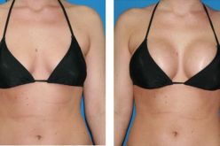 What is the Recovery Stages of Breast Implant Surgery?