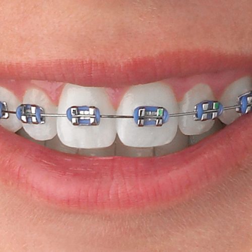 Quick Tips On How To Floss When You Have Braces