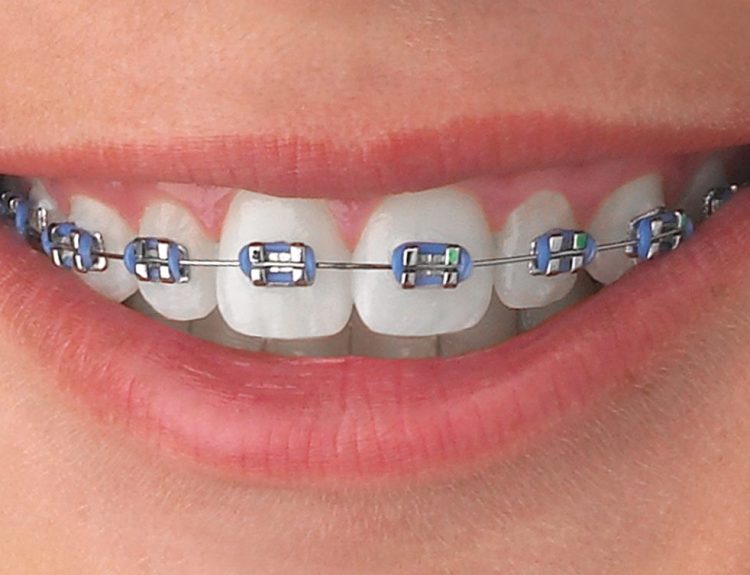 Quick Tips On How To Floss When You Have Braces