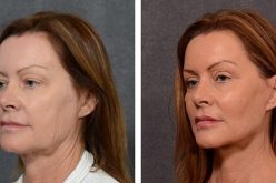 What You Should Know About Having A Neck Lift
