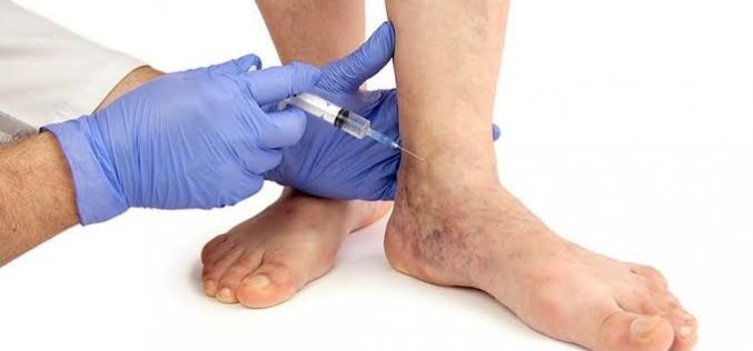 Which is the best treatment for a varicose vein?