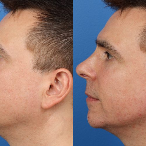 JAW ENHANCEMENT SURGERY DIVING INTO THE DETAILS OF AVAILABLE OPTIONS IN CURRENT TIMES