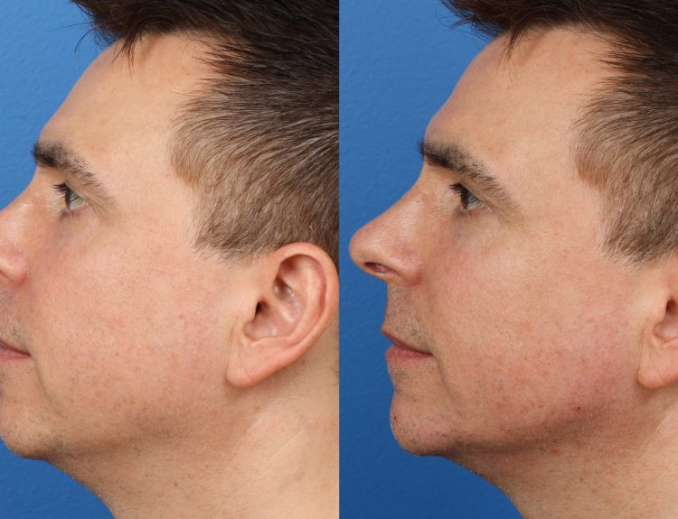 JAW ENHANCEMENT SURGERY DIVING INTO THE DETAILS OF AVAILABLE OPTIONS IN CURRENT TIMES