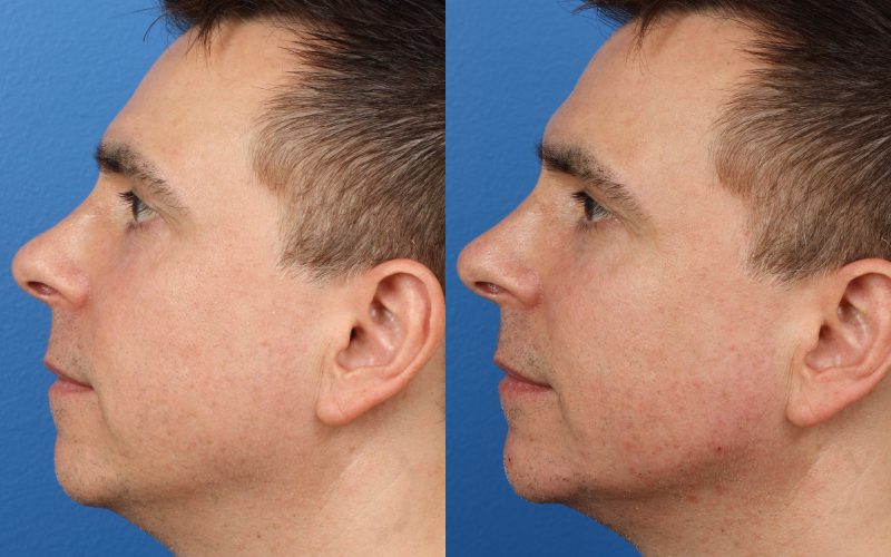 JAW ENHANCEMENT SURGERY DIVING INTO THE DETAILS OF AVAILABLE OPTIONS IN CURRENT TIMES