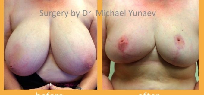 6 Things To Know If You Want To Have Breast Reduction Surgery