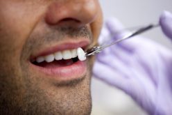 How To Maximise The Life Of Your Porcelain Veneers