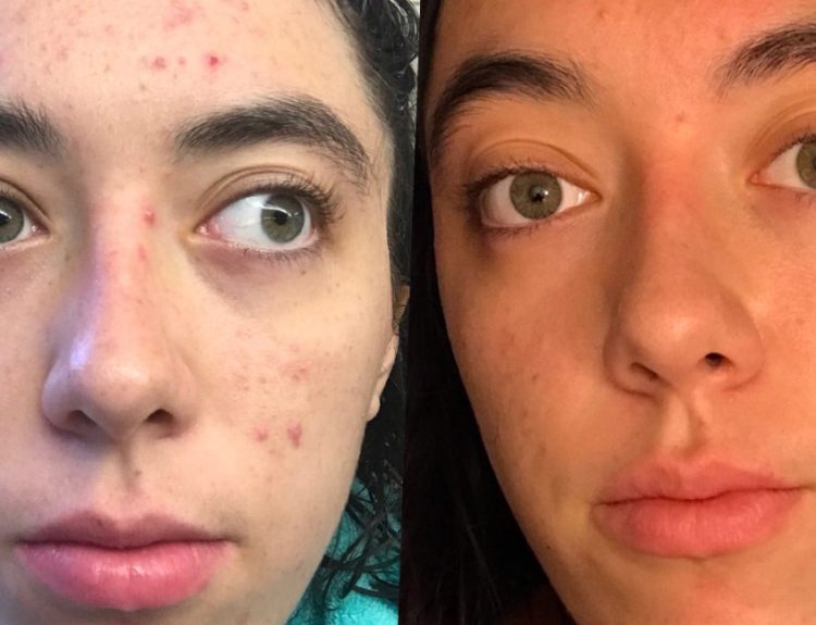 The Benefits of Using a Dark Spot Correcting Serum