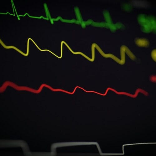 Close-up of a heartbeat monitor displaying colorful ECG readings
